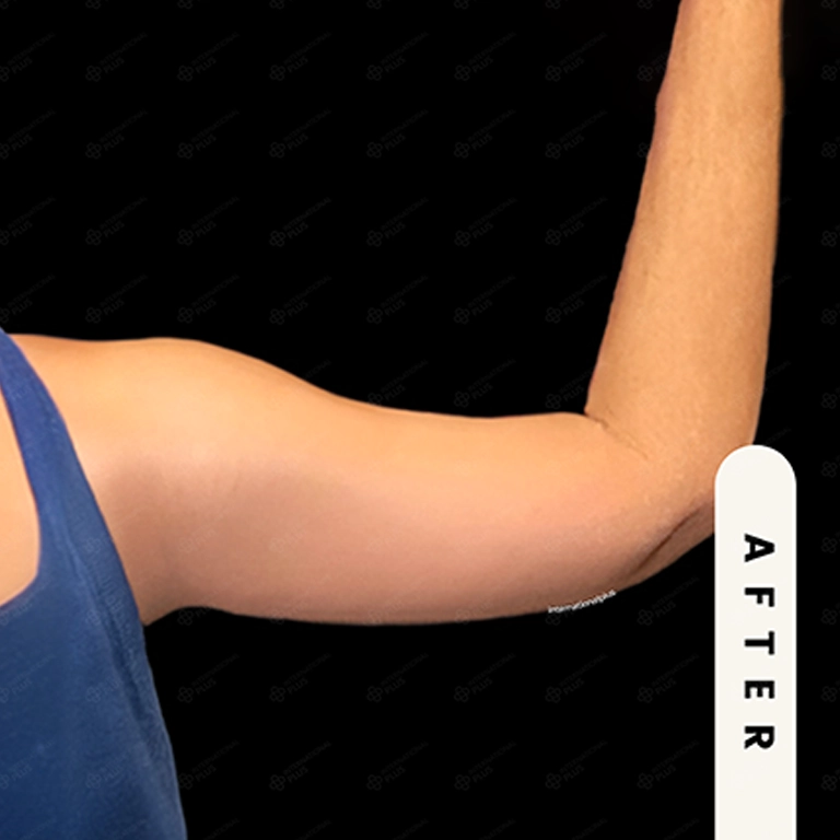 arm lift before after 2