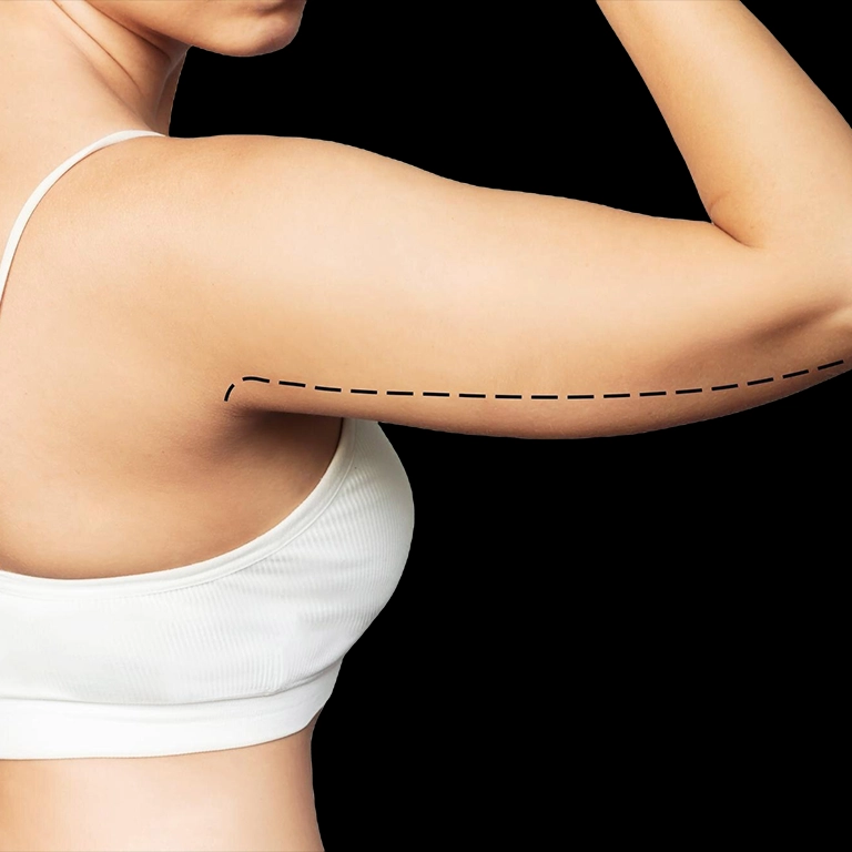 Повдигане на ръката (преди след)