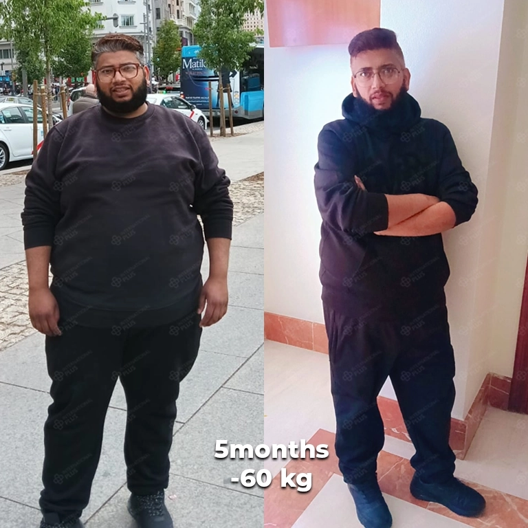 bariatric surgery before after 1