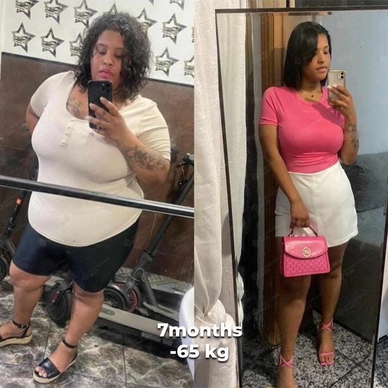 bariatric surgery before after 10