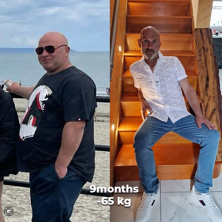 bariatric surgery before after 11