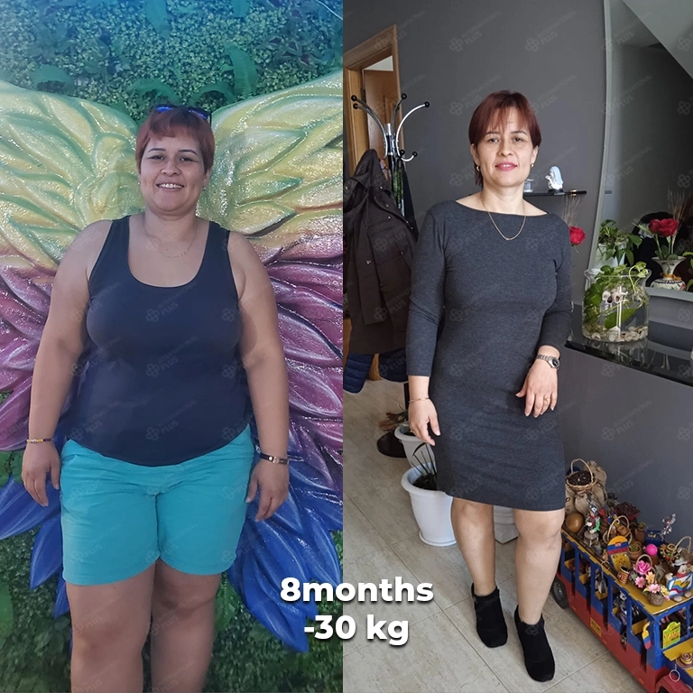 bariatric surgery before after 13