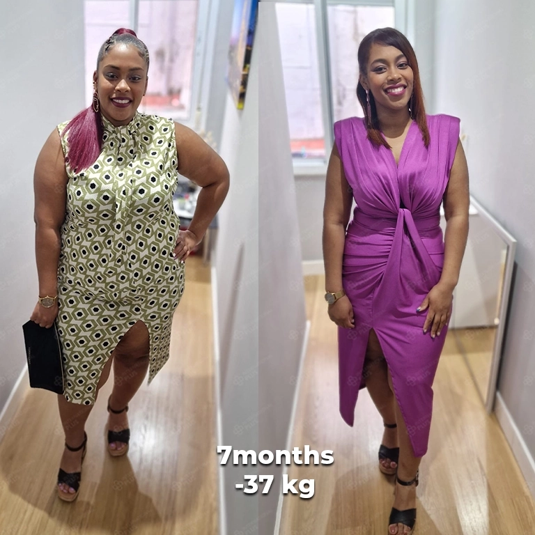 bariatric surgery before after 16