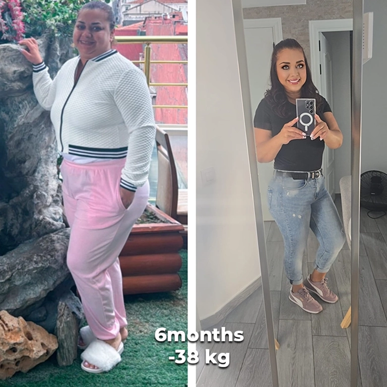 bariatric surgery before after 3