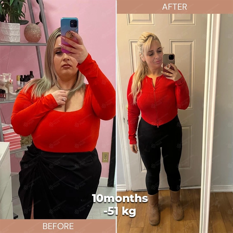 bariatric surgery before after 8