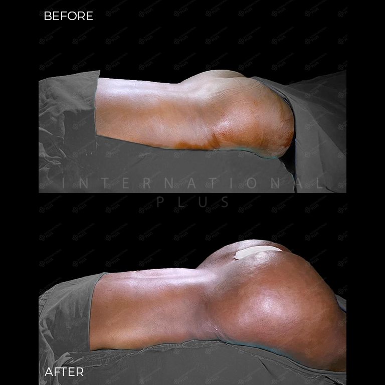 brazilian butt lift bbl before after 25