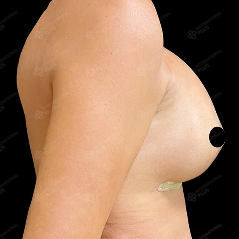 breast surgery before after 12