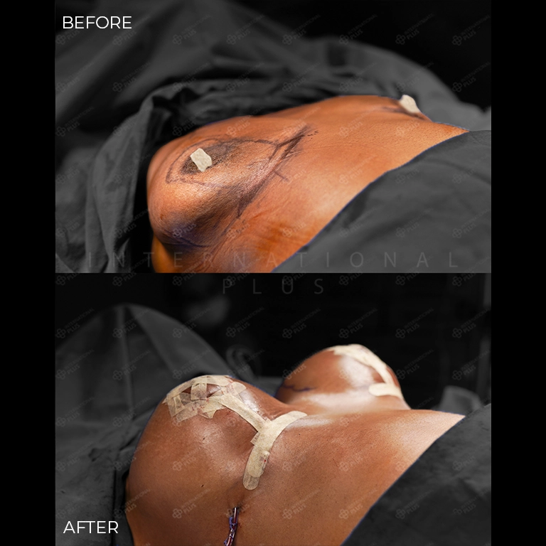 breast surgery before after 13