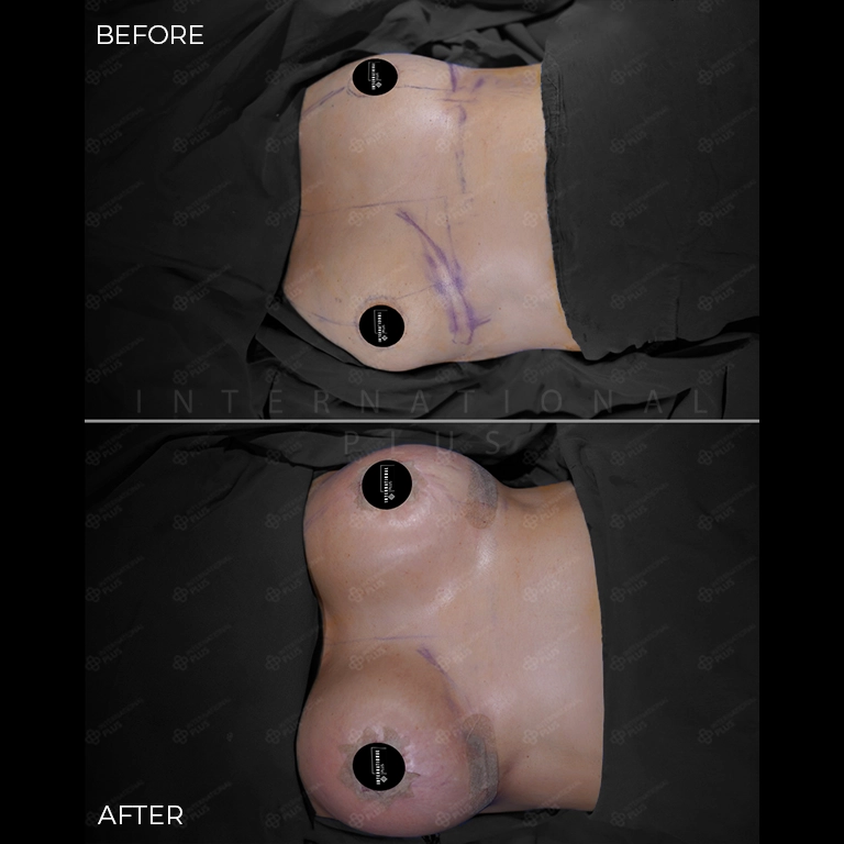 breast surgery before after 14