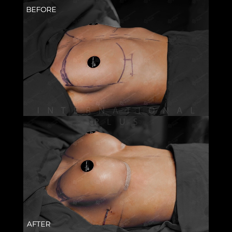 breast surgery before after 15