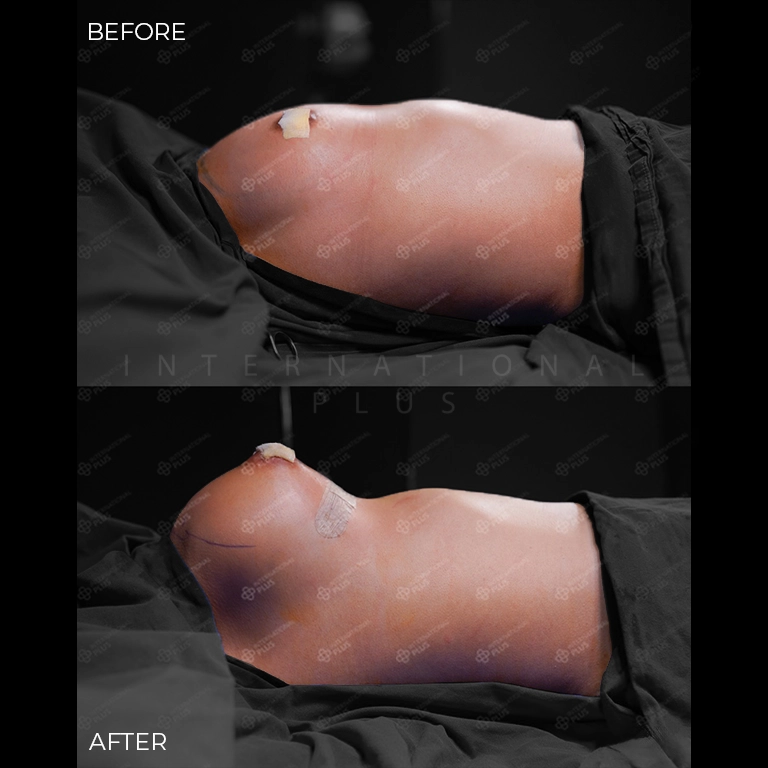 breast surgery before after 18