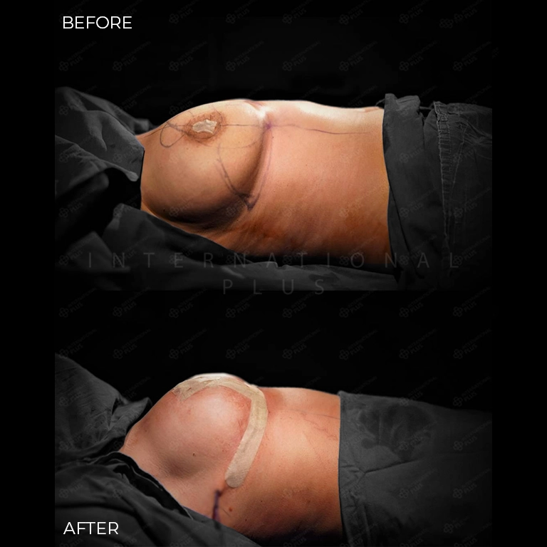 breast surgery before after 19