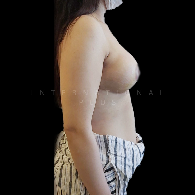 breast surgery before after 2