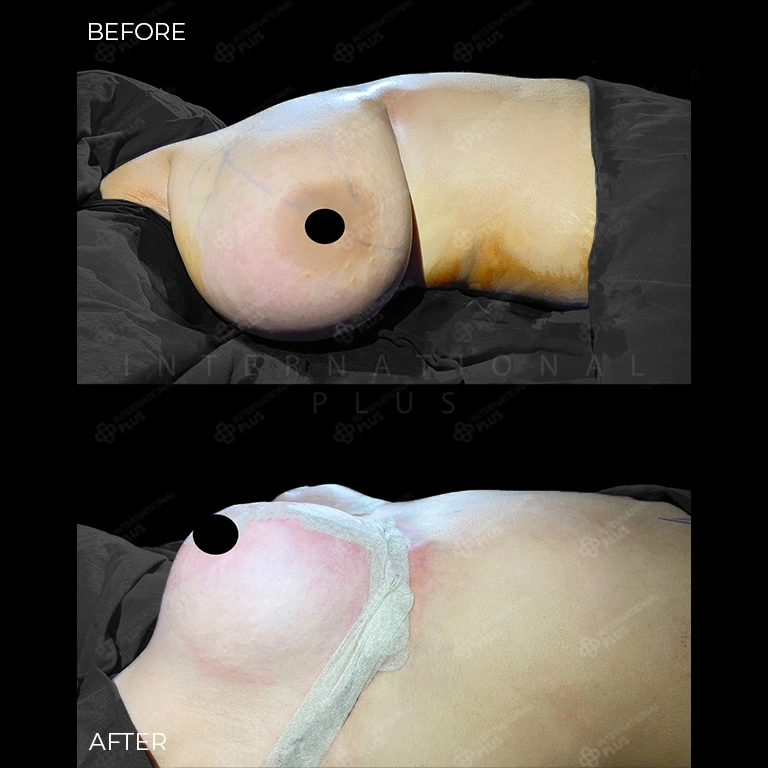 breast surgery before after 20