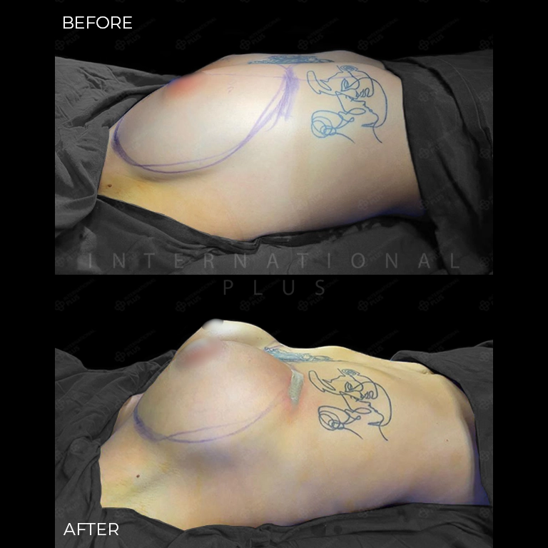 breast surgery before after 27