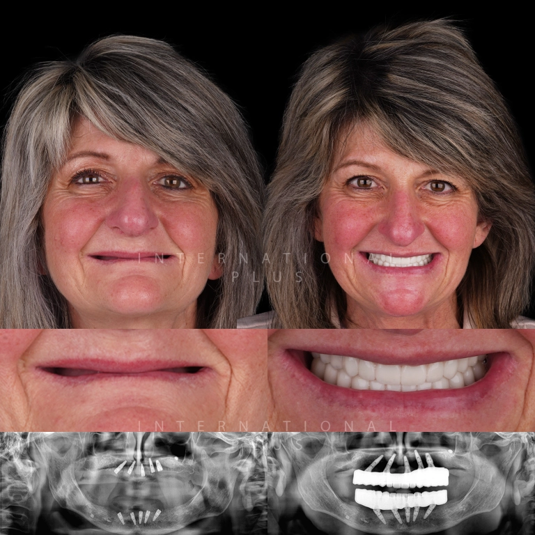 dental all on systems before after 1