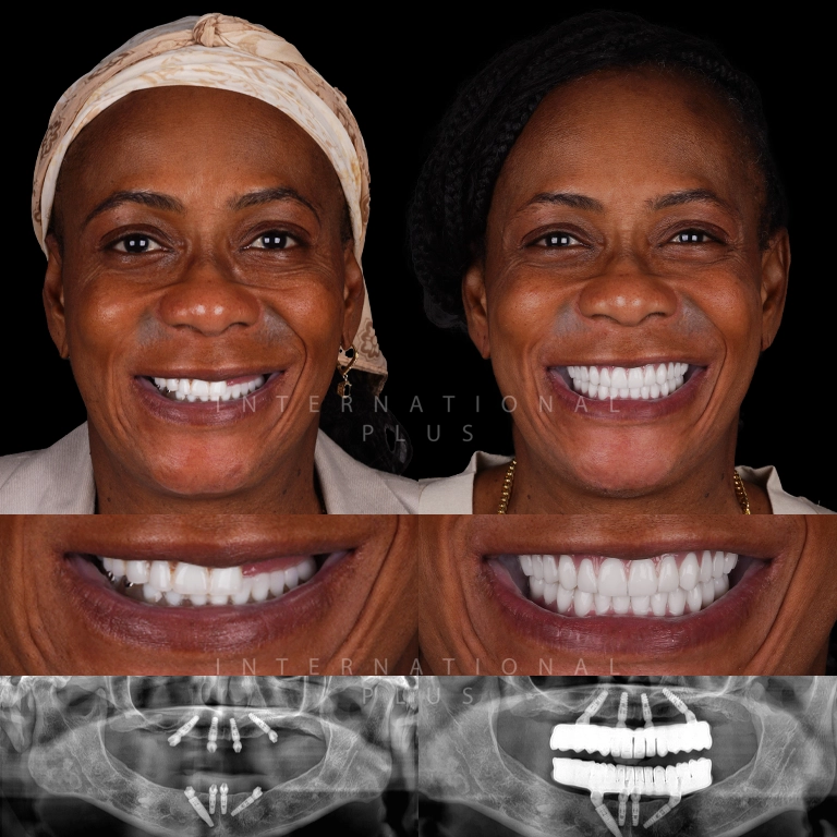 dental all on systems before after 10