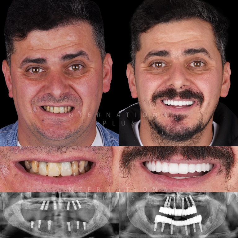 dental all on systems before after 2