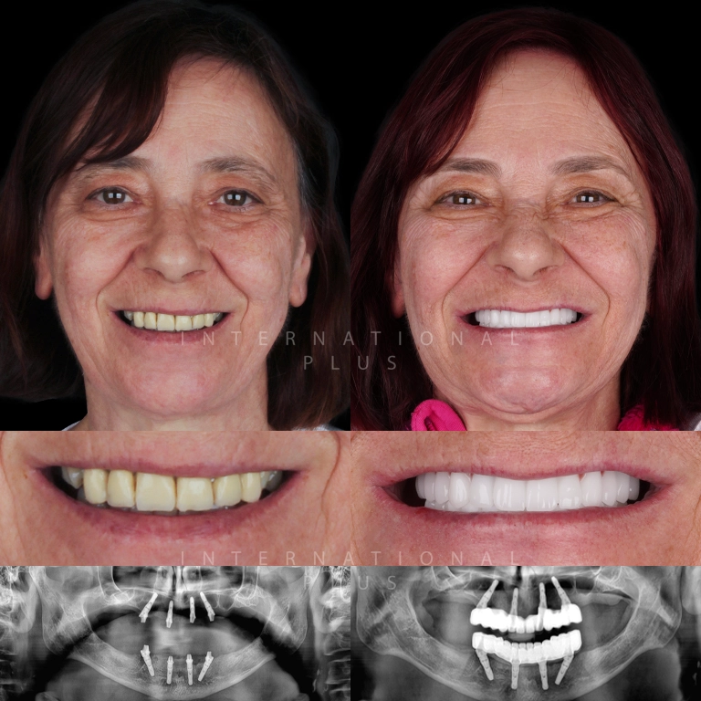 dental all on systems before after 3