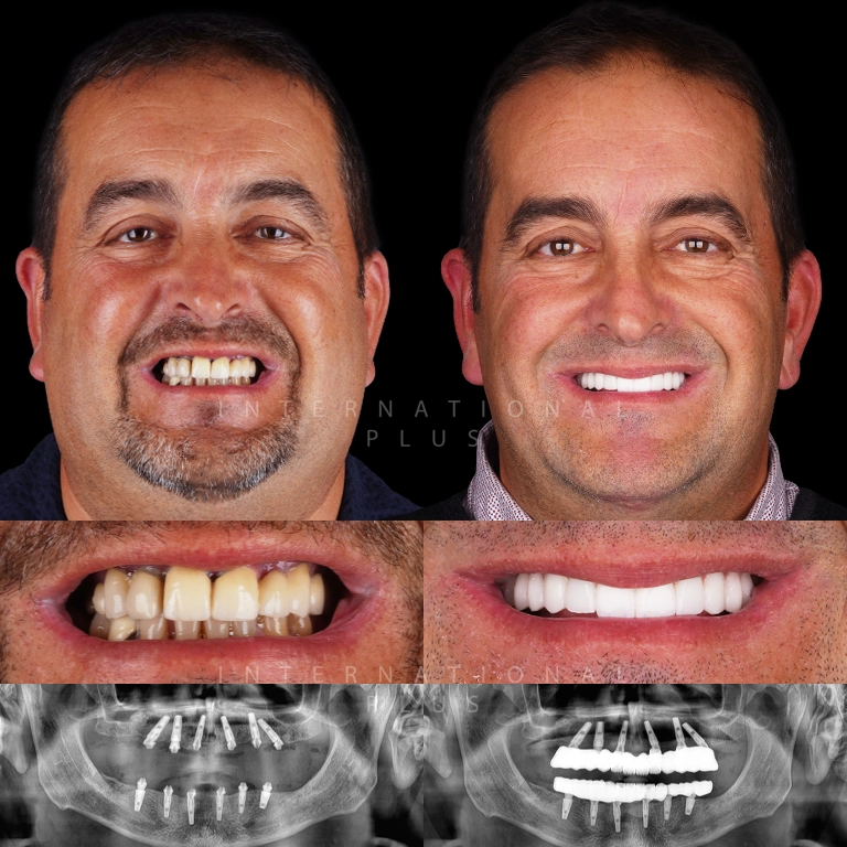 dental all on systems before after 4