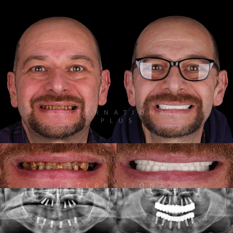 dental all on systems before after 5