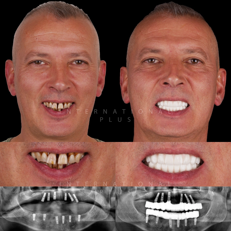 dental all on systems before after 6