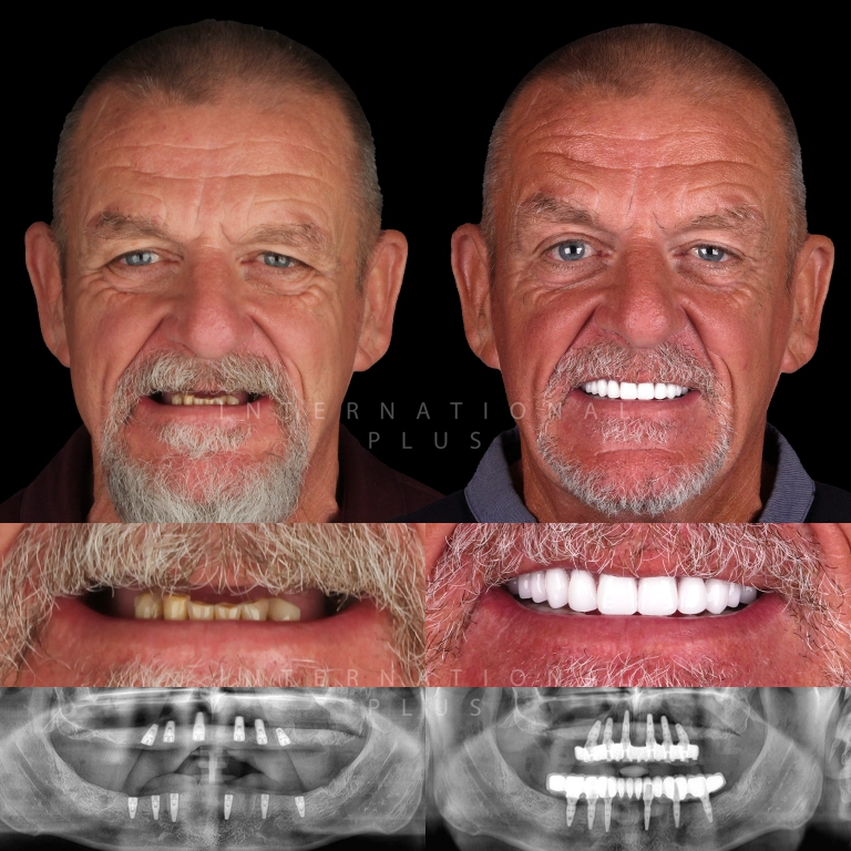 dental all on systems before after 7