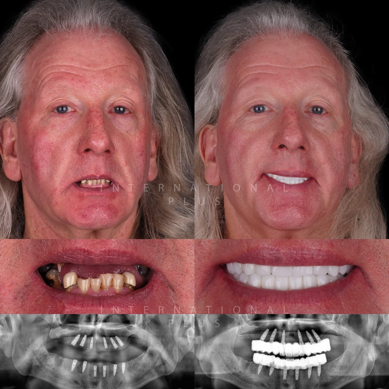 dental all on systems before after 8