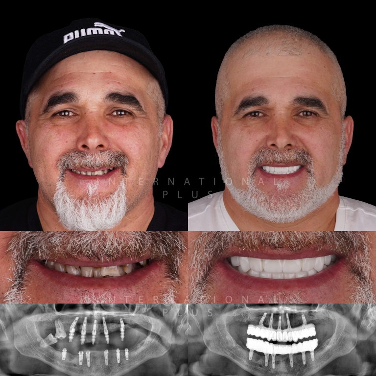 dental all on systems before after 9