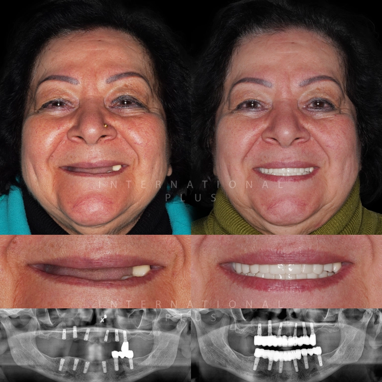 Dental Implant Before After 1