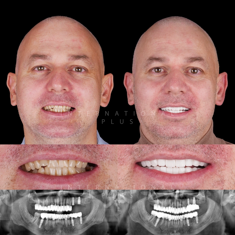 dental implant before after 10