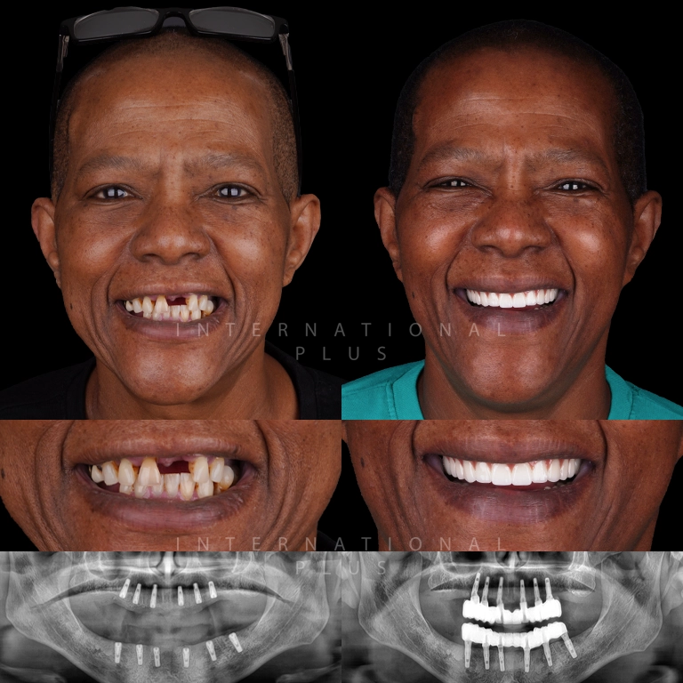 Dental Implant Before After 2