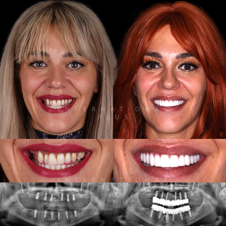 dental implant before after 3