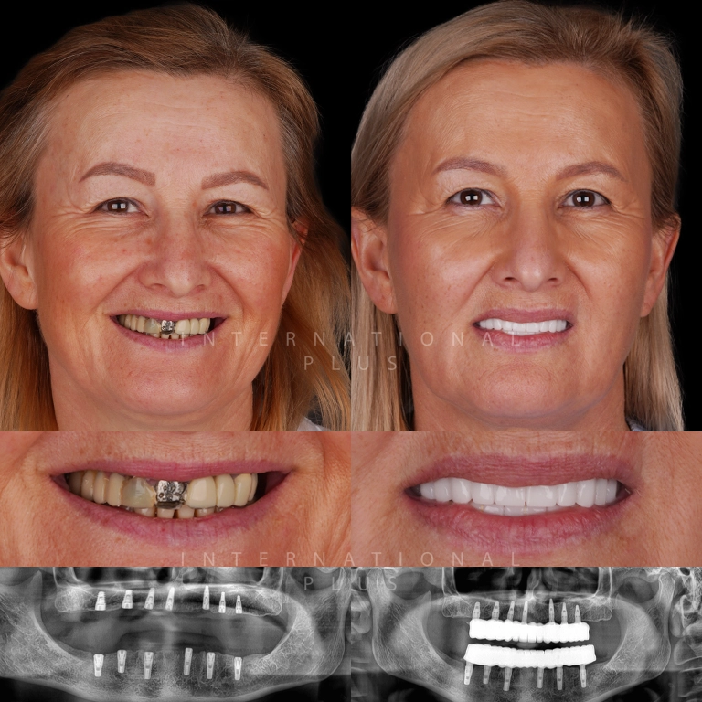 dental implant before after 4