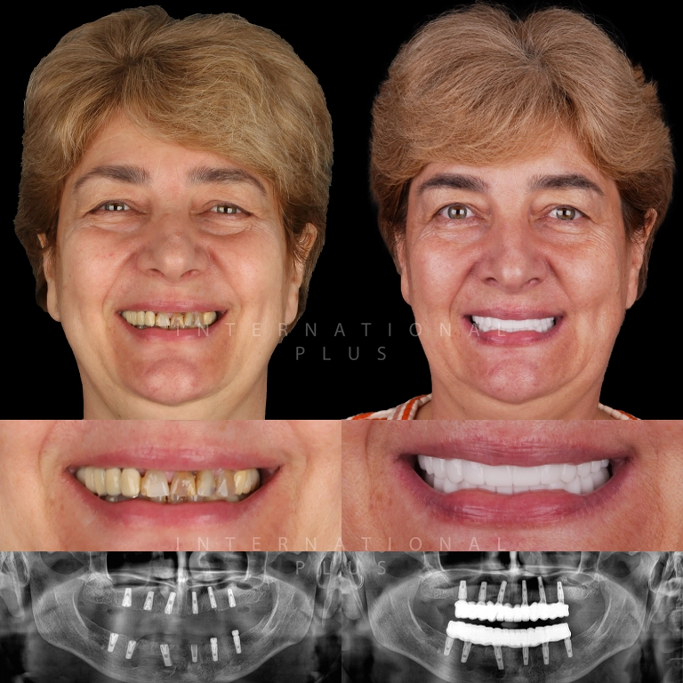 dental implant before after 5