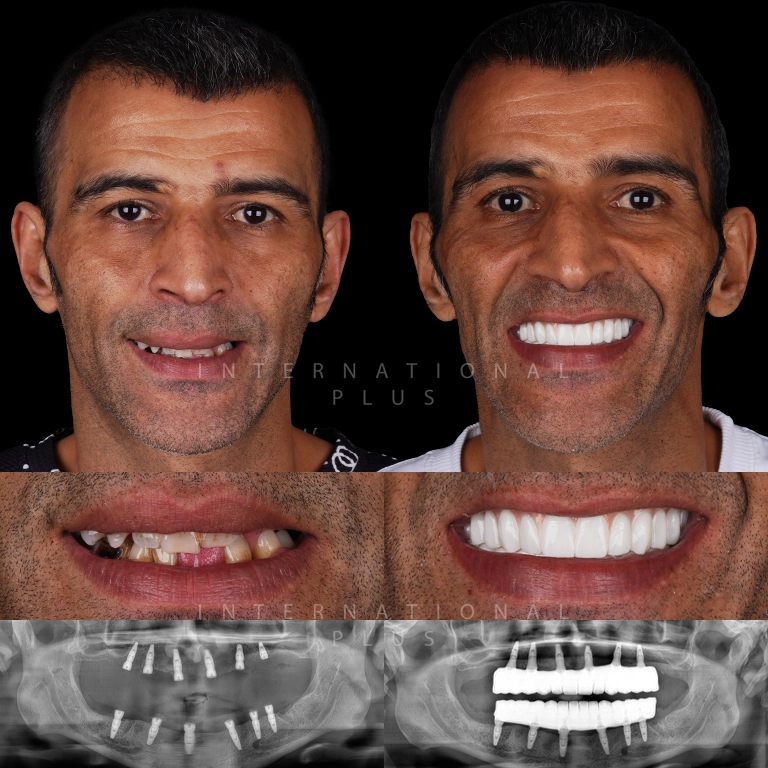 dental implant before after 6