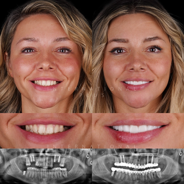 dental implant before after 7