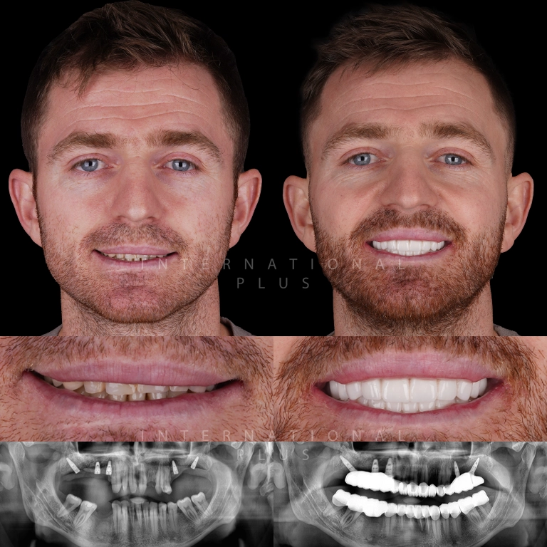 dental implant before after 8