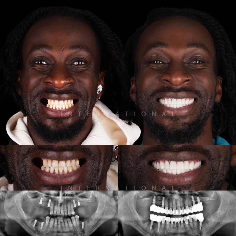 dental implant before after 9