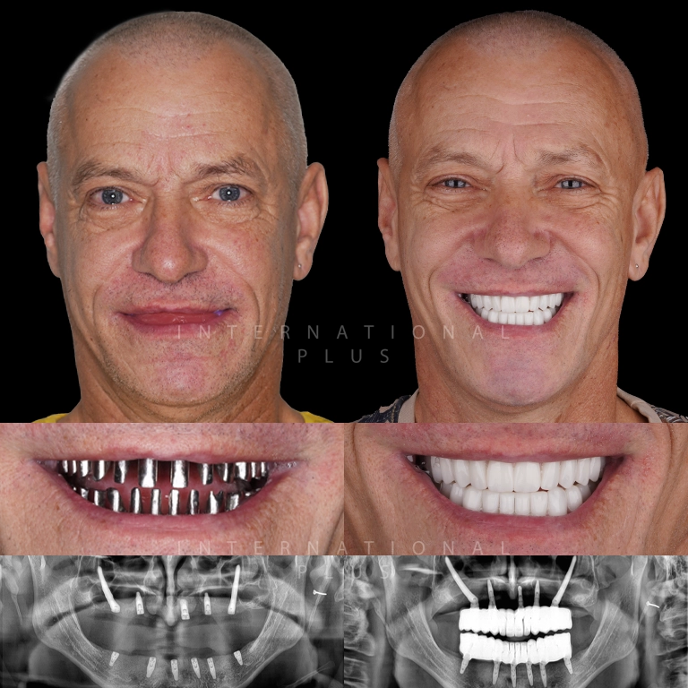 dental toronto before after 2