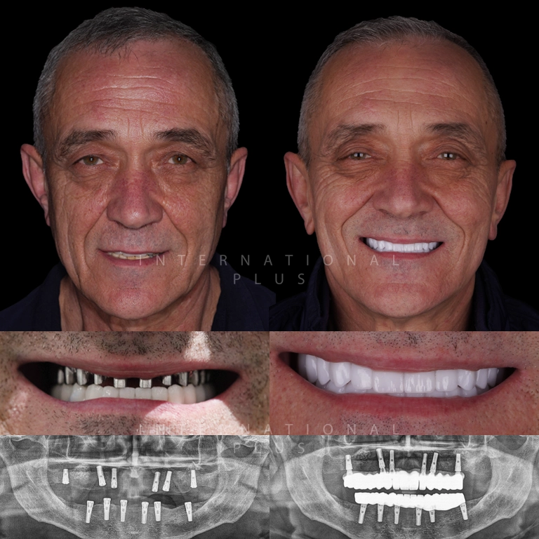 dental toronto before after 8