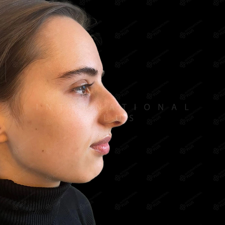 rhinoplasty before after 1