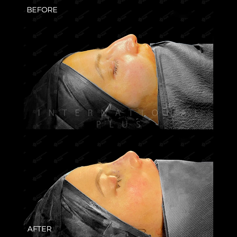 rhinoplasty before after 14