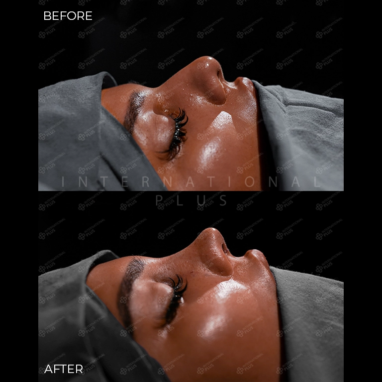 rhinoplasty before after 15