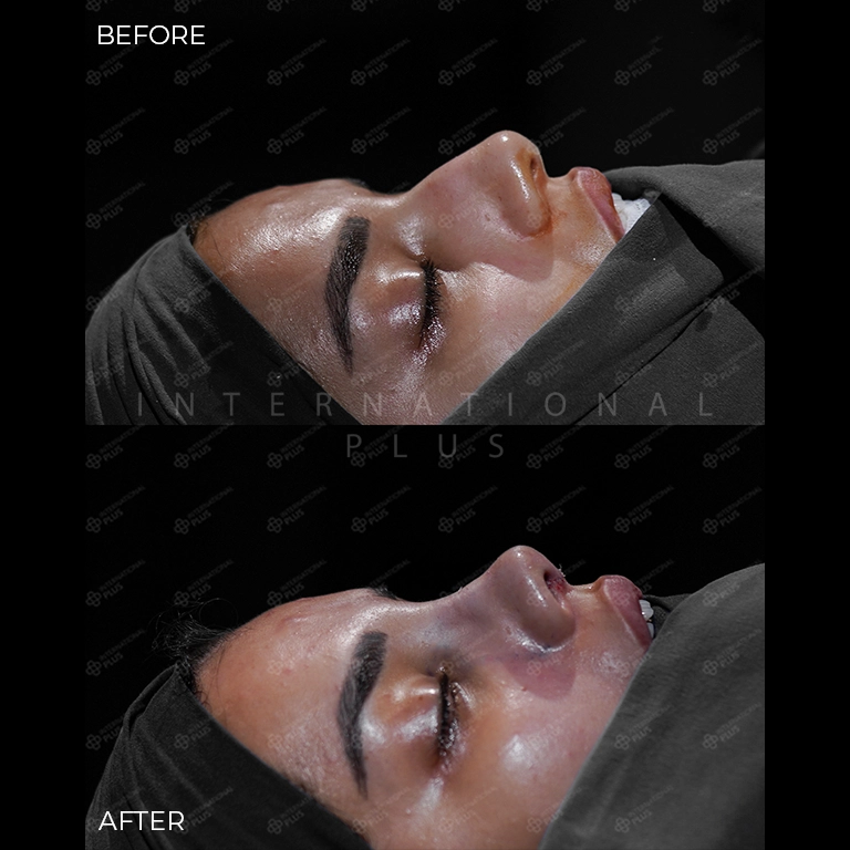 rhinoplasty before after 17