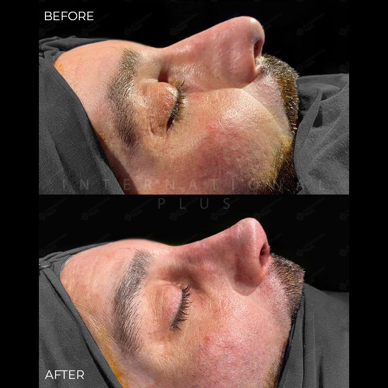 rhinoplasty before after 20