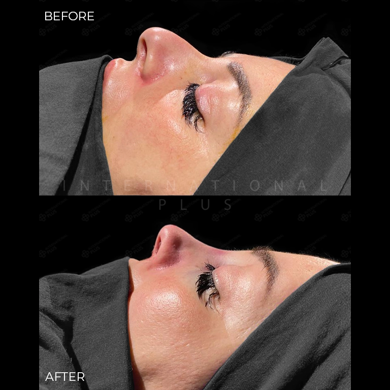 rhinoplasty before after 22