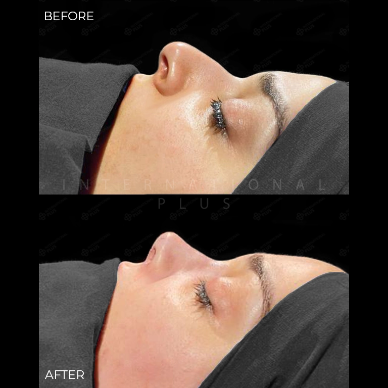 rhinoplasty before after 23