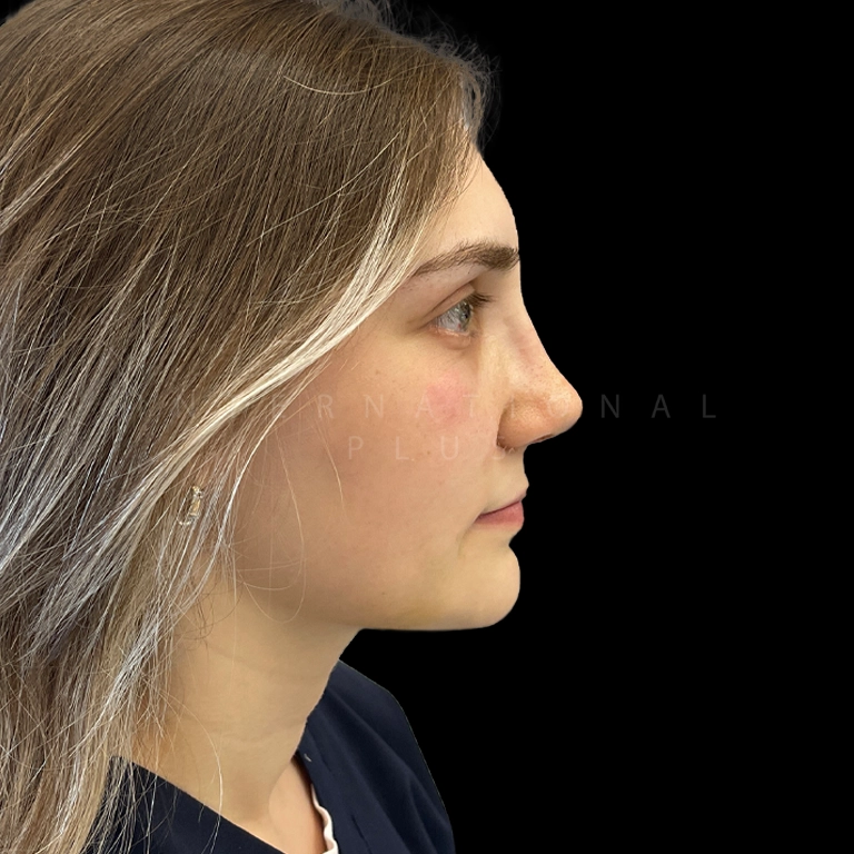 rhinoplasty before after 32