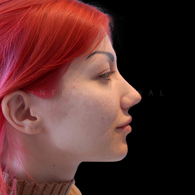 rhinoplasty before after 33